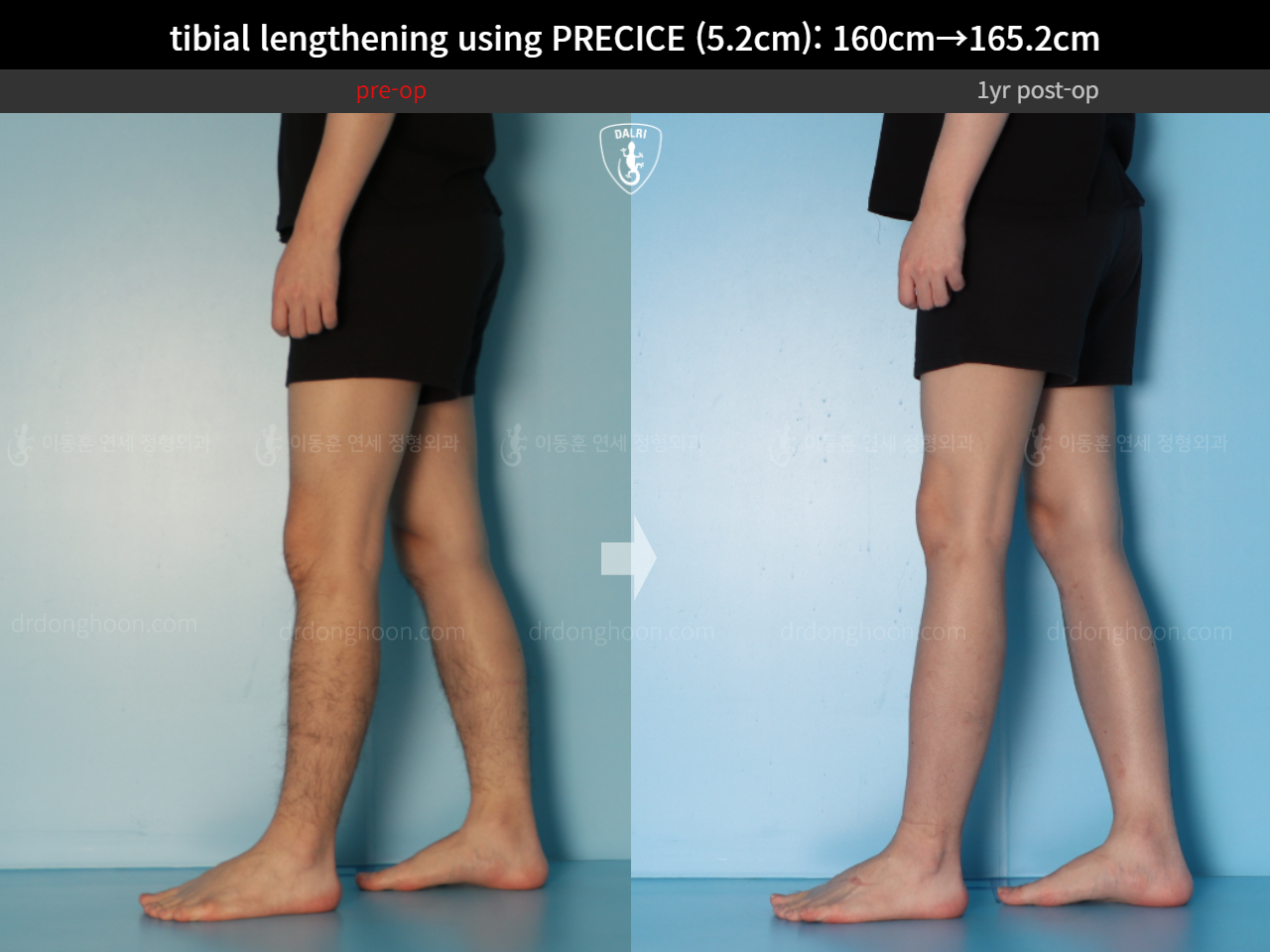 Before and after cll precice, case 15213098, image 12, Dr. Donghoon institute (DALRI)