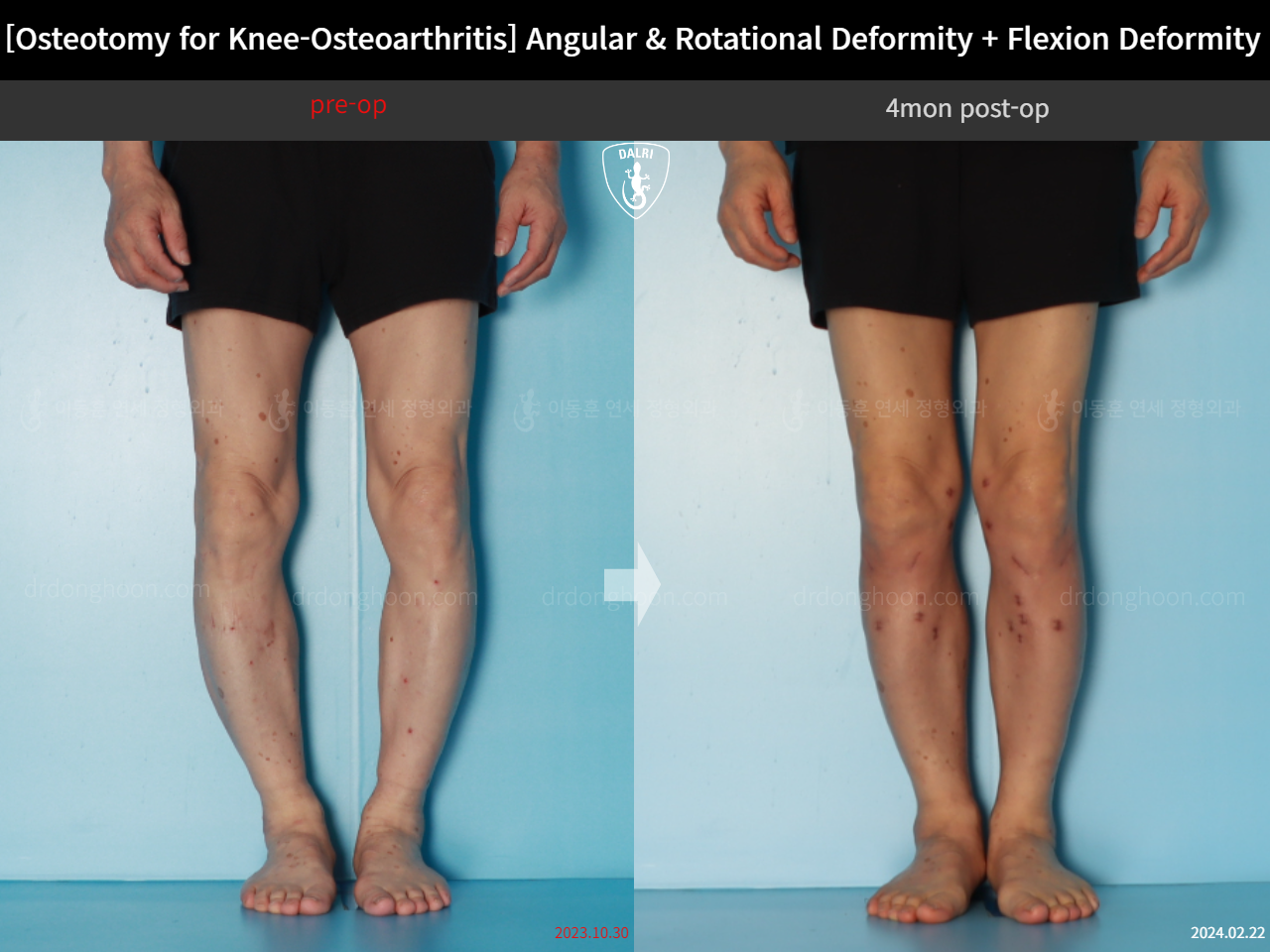 Before and after osteotomy for knee osteoarthritis, case 18162350, image 7, Dr. Donghoon institute (DALRI)