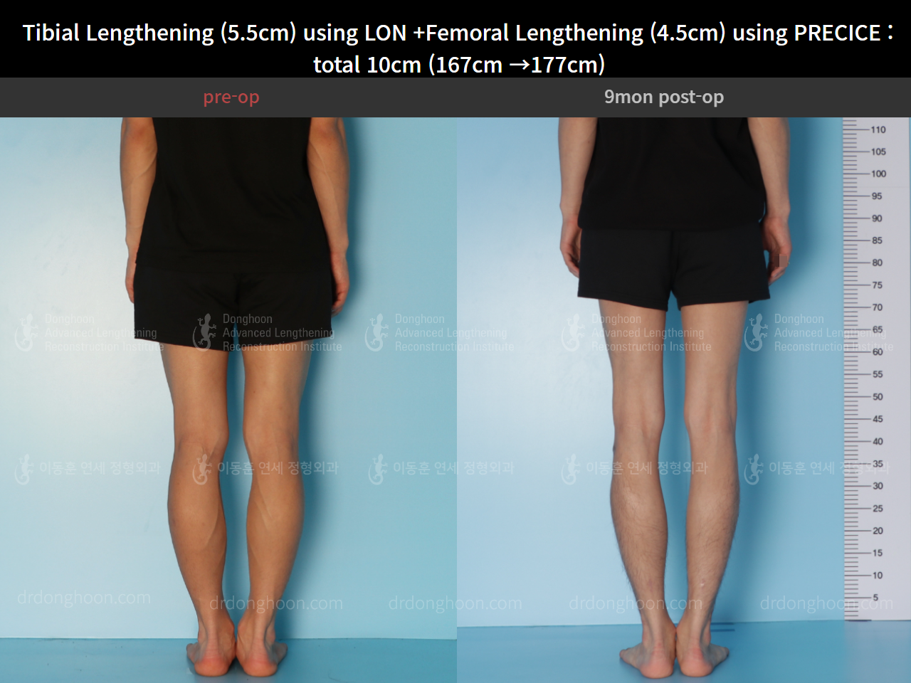 Before and after cll precice, case 4662233, image 6, Dr. Donghoon institute (DALRI)