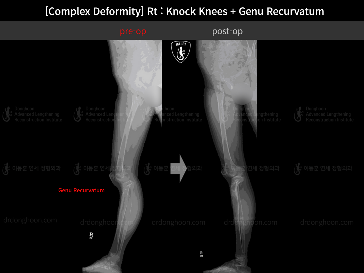 Before and after adult knock knees, case 4586324, image 6, Dr. Donghoon institute (DALRI)