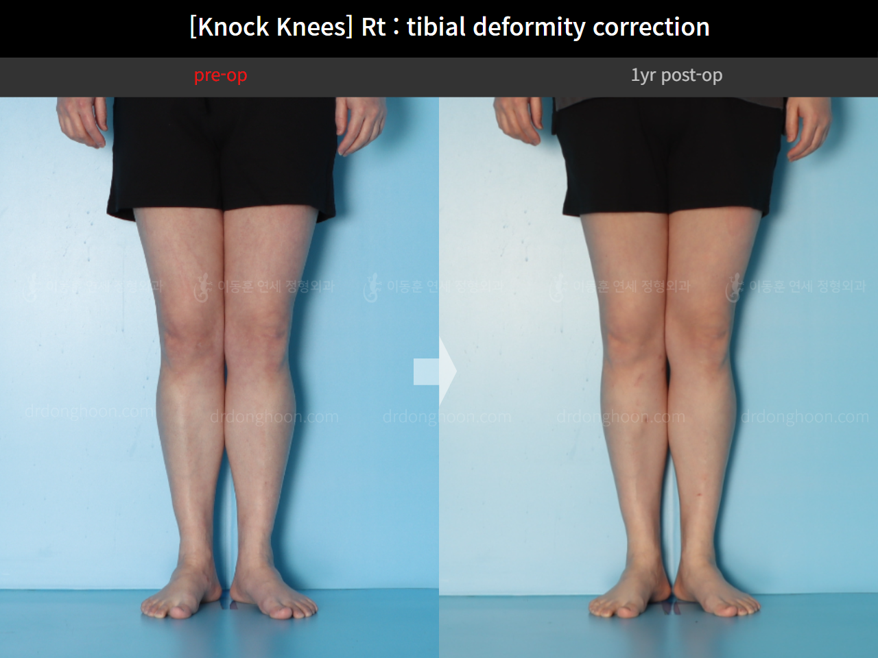 Before and after adult knock knees, case 18411627, image 6, Dr. Donghoon institute (DALRI)
