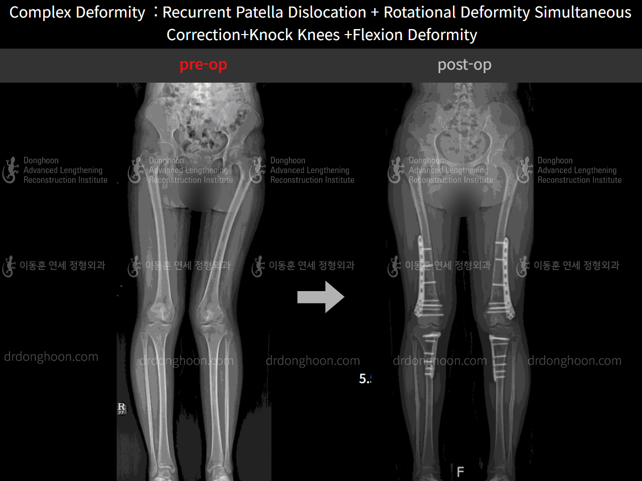 Before and after recurrent patella dislocation, case 4263760, image 6, Dr. Donghoon institute (DALRI)