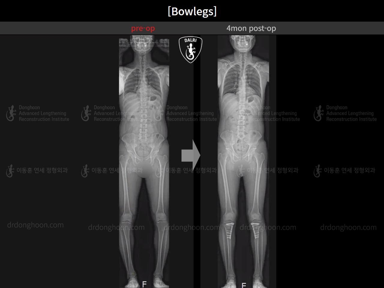 Before and after adult bowlegs, case 15650289, image 8, Dr. Donghoon institute (DALRI)