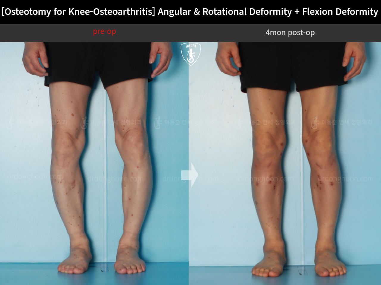 Before and after osteotomy for knee osteoarthritis, case 18162350, image 9, Dr. Donghoon institute (DALRI)
