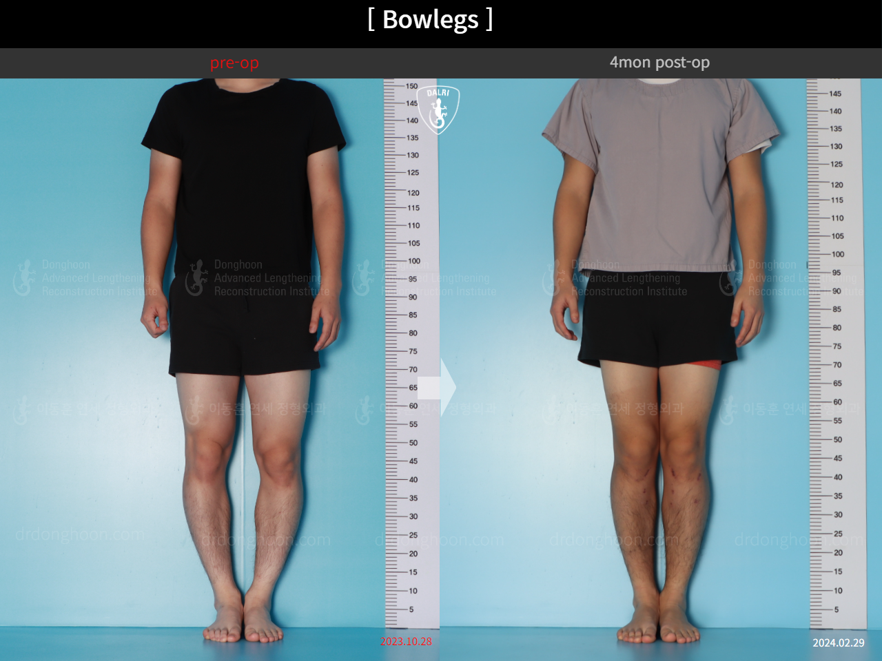 Before and after adult bowlegs, case 18479637, image 1, Dr. Donghoon institute (DALRI)