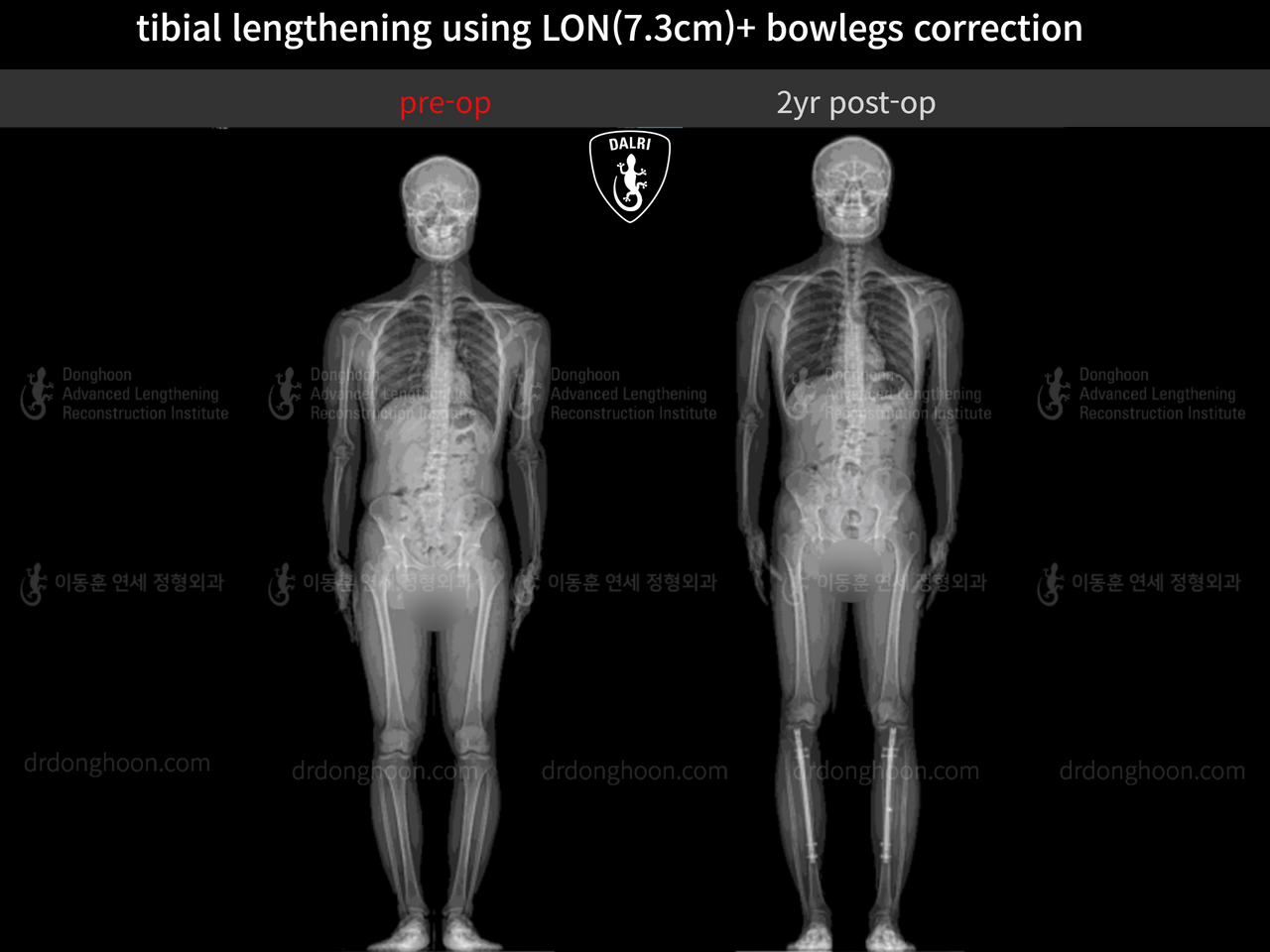 Before and after cll + deformity correction, case 13549657, image 1, Dr. Donghoon institute (DALRI)