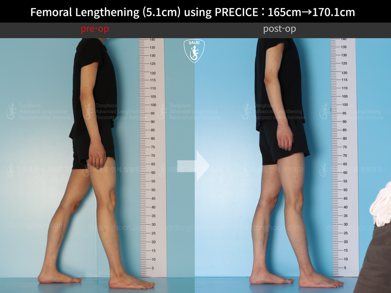 Before and after cll precice, case 13184743, image 3, Dr. Donghoon institute (DALRI)