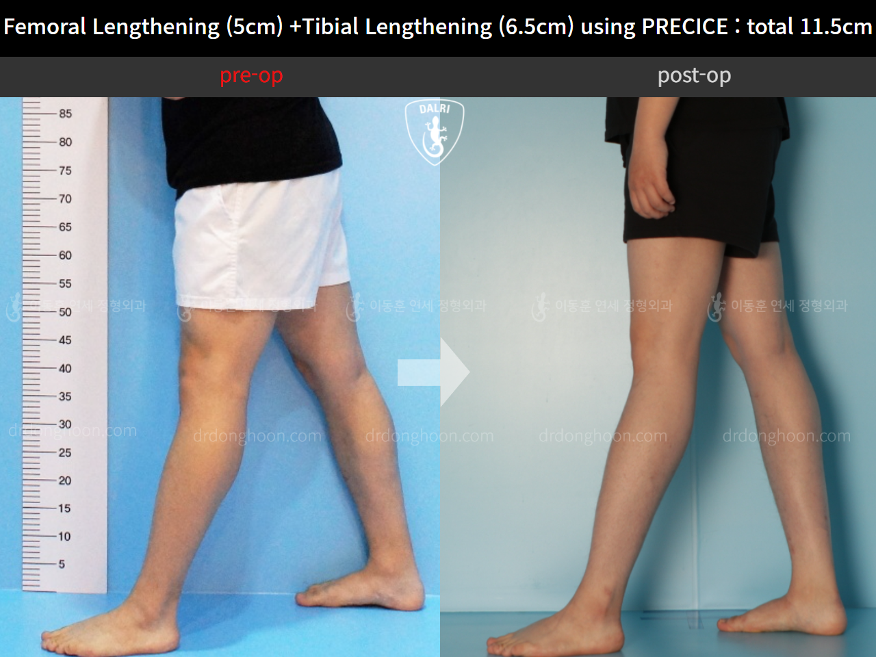 Before and after cll precice, case 11324647, image 10, Dr. Donghoon institute (DALRI)