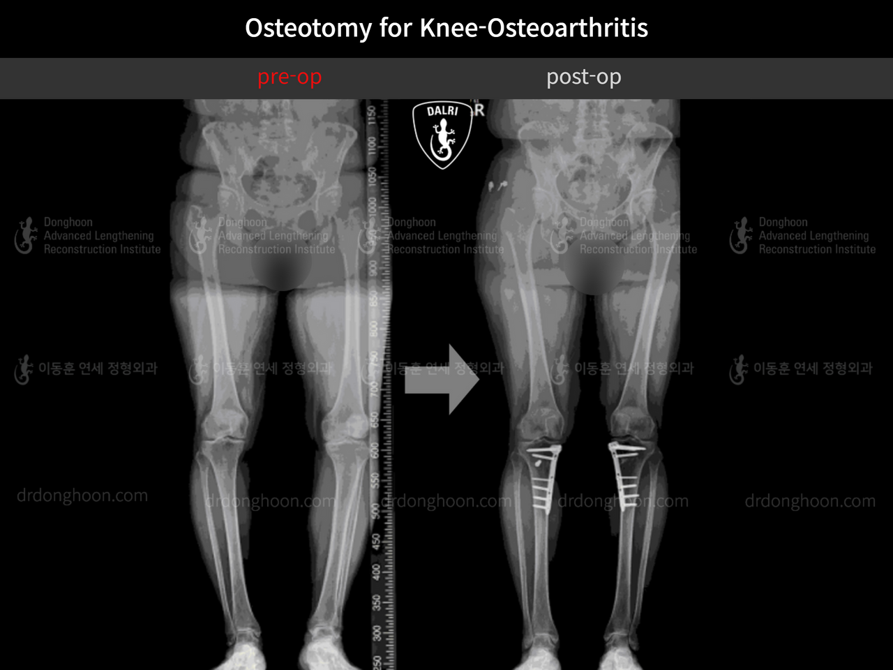 Before and after osteotomy for knee osteoarthritis, case 13231794, image 6, Dr. Donghoon institute (DALRI)