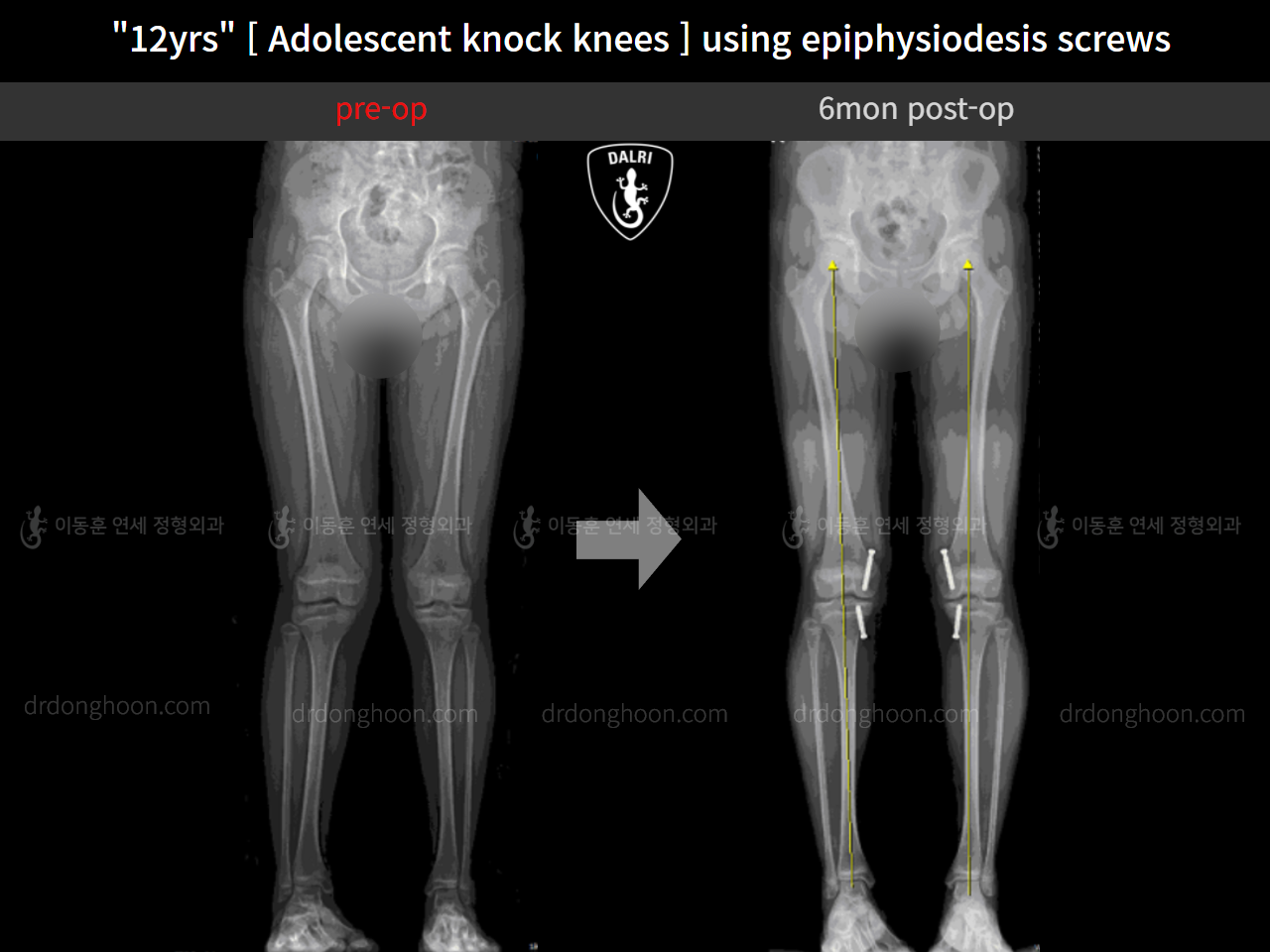 Before and after paediatric & adolescent knock knees, case 11772990, image 6, Dr. Donghoon institute (DALRI)