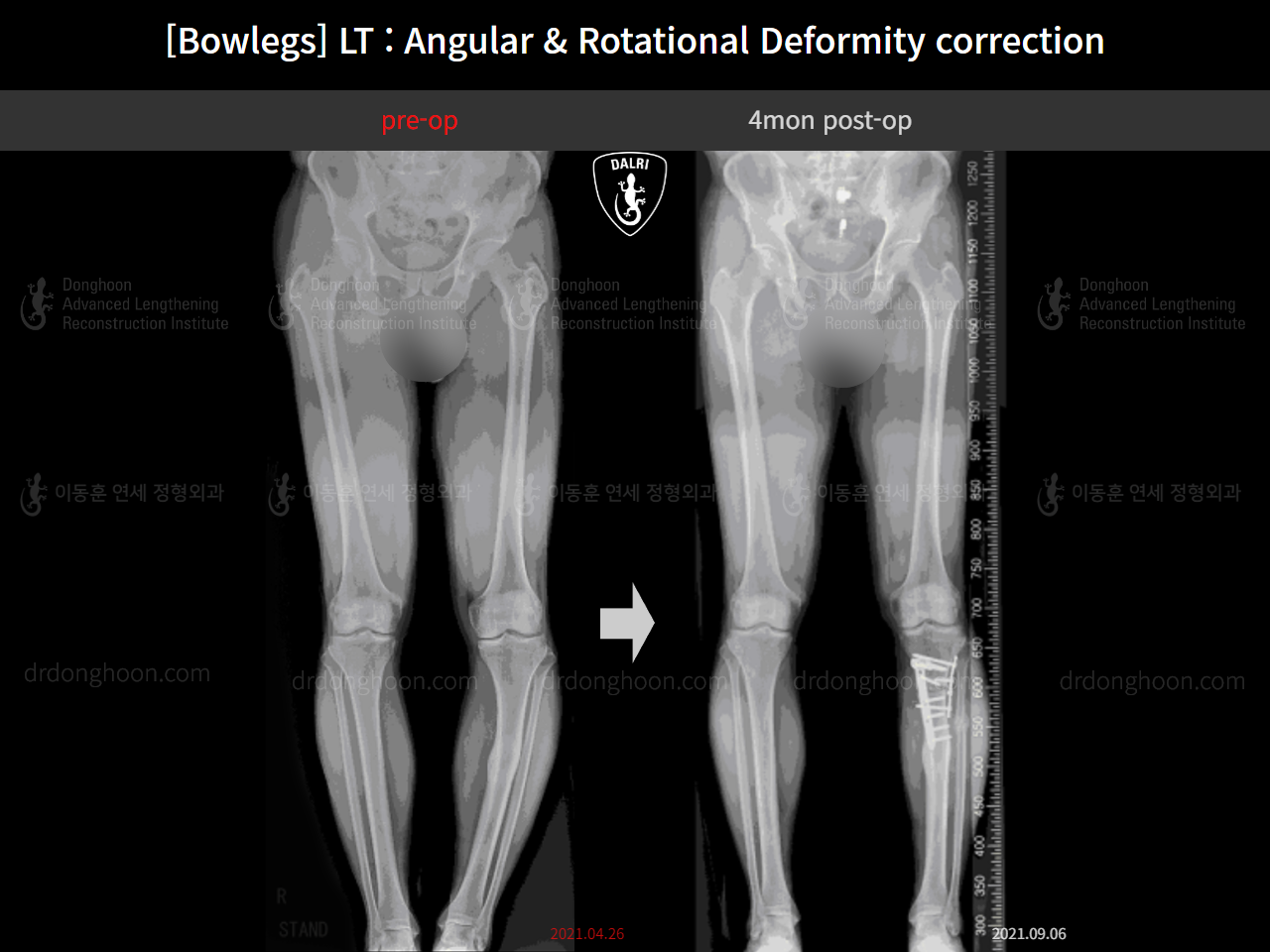Before and after adult bowlegs, case 15111863, image 11, Dr. Donghoon institute (DALRI)