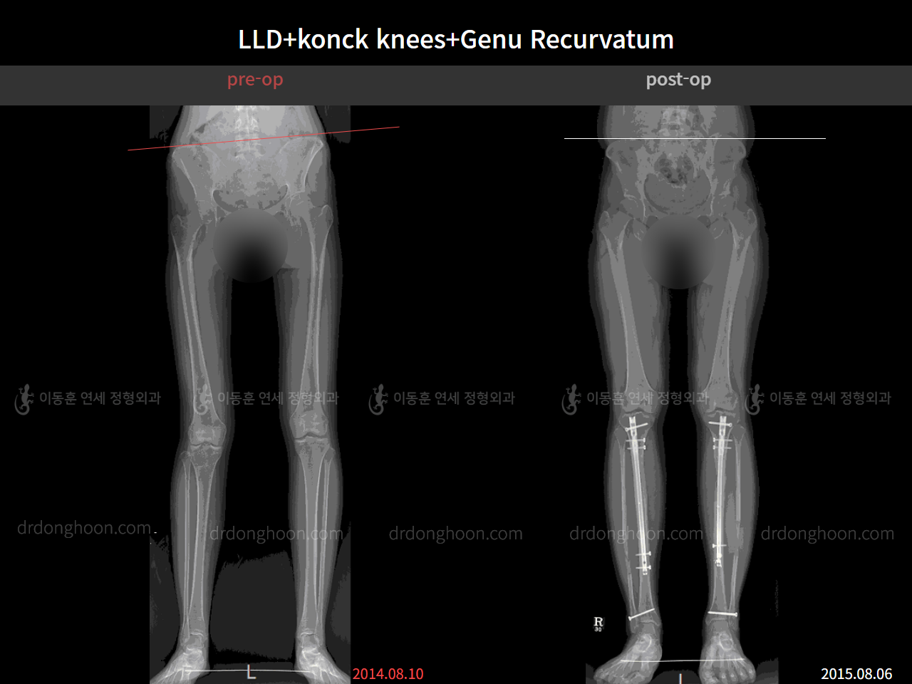 Before and after complex deformity, case 4574860, image 4, Dr. Donghoon institute (DALRI)