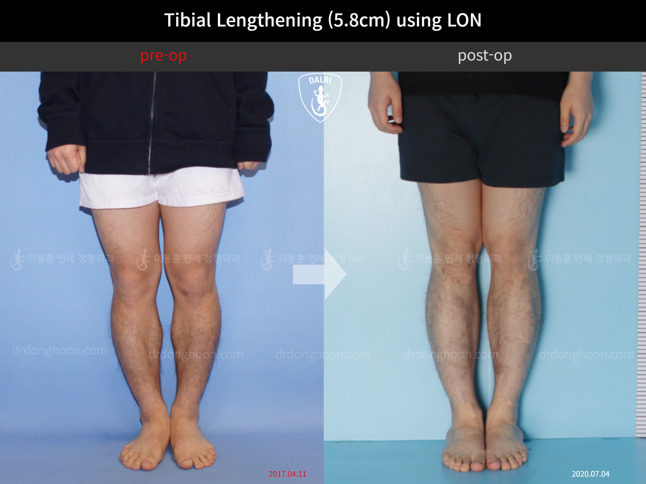 Before and after cll lon, case 4577732, image 5, Dr. Donghoon institute (DALRI)
