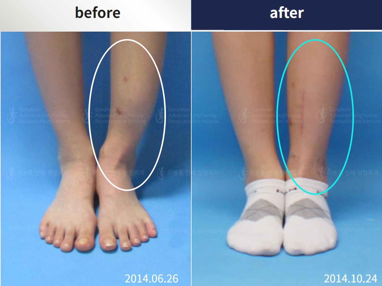 Before and after foot & ankle deformity, case 4354996, image 1, Dr. Donghoon institute (DALRI)