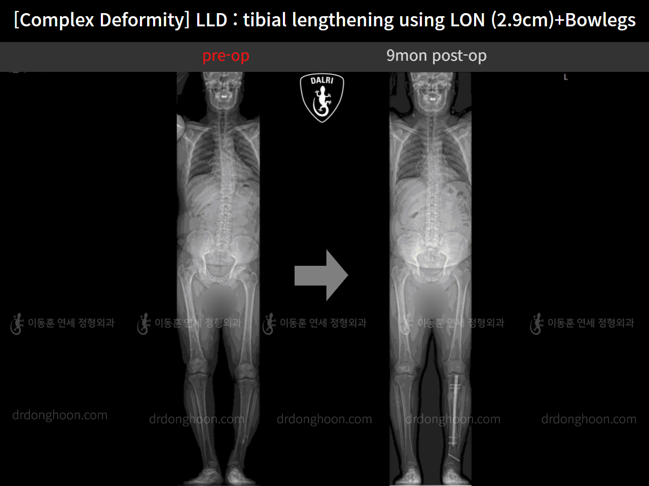 Before and after adult lld, case 11233977, image 7, Dr. Donghoon institute (DALRI)
