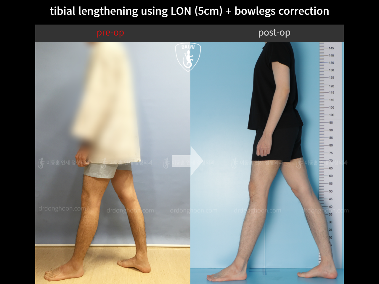 Before and after cll + deformity correction, case 4323130, image 4, Dr. Donghoon institute (DALRI)