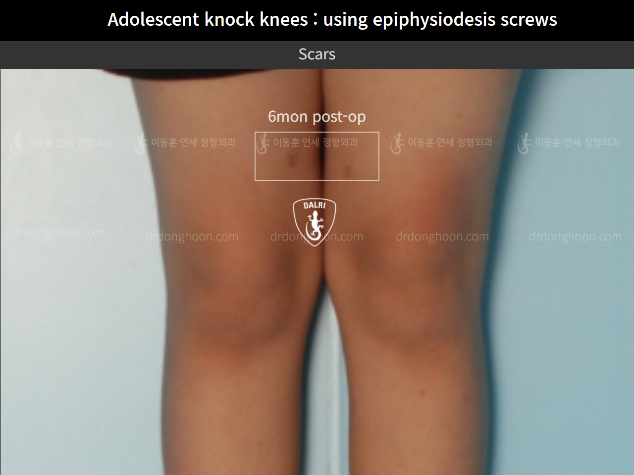 Before and after paediatric & adolescent knock knees, case 9626556, image 5, Dr. Donghoon institute (DALRI)