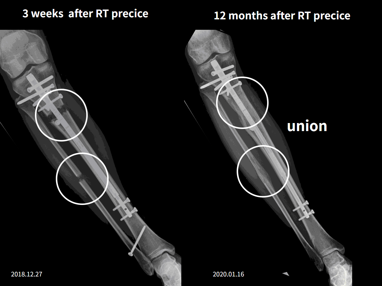 Before and after re-operation for cll, case 4528255, image 6, Dr. Donghoon institute (DALRI)