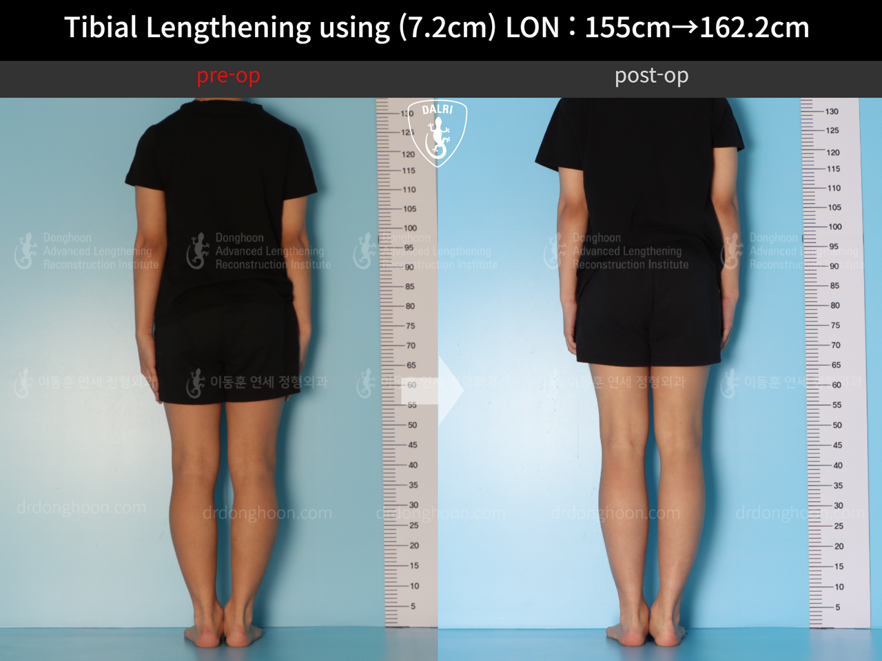 Before and after cll lon, case 13635674, image 2, Dr. Donghoon institute (DALRI)
