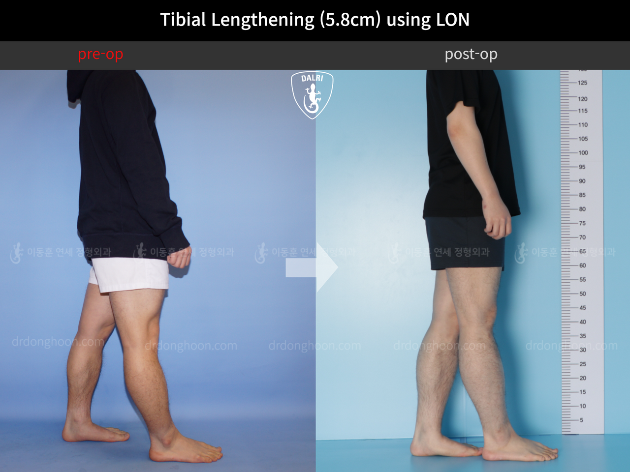 Before and after cll lon, case 4577732, image 4, Dr. Donghoon institute (DALRI)