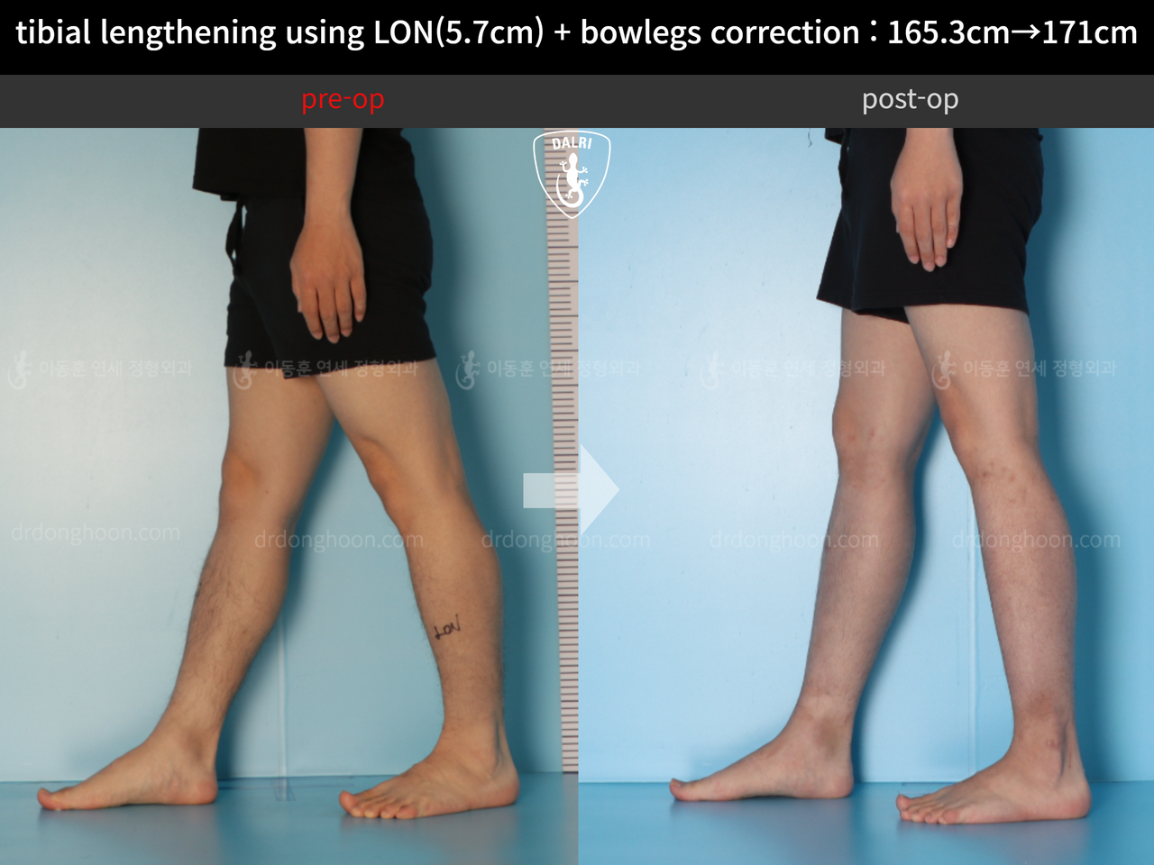 Before and after cll lon, case 12679171, image 7, Dr. Donghoon institute (DALRI)