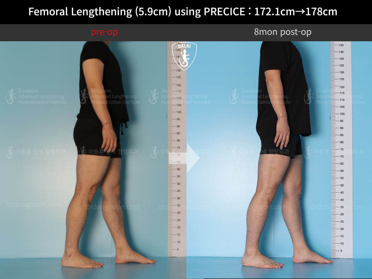 Before and after cll precice, case 13848850, image 7, Dr. Donghoon institute (DALRI)