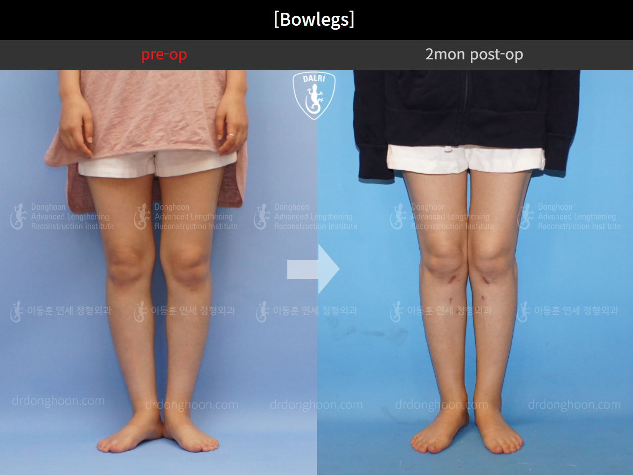 Before and after adult bowlegs, case 4310993, image 6, Dr. Donghoon institute (DALRI)