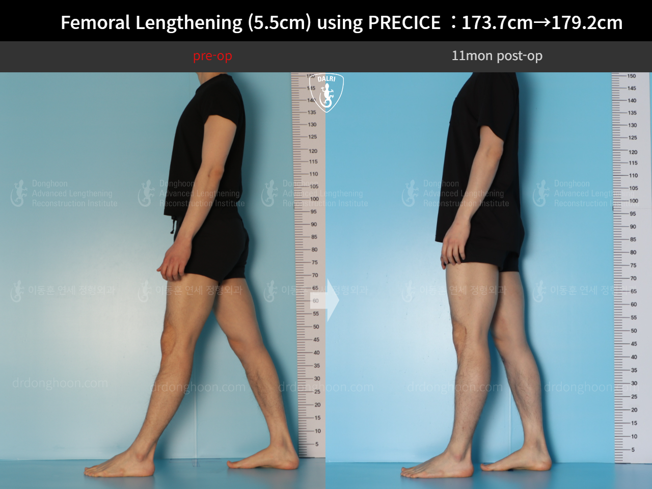 Before and after cll precice, case 18140453, image 6, Dr. Donghoon institute (DALRI)