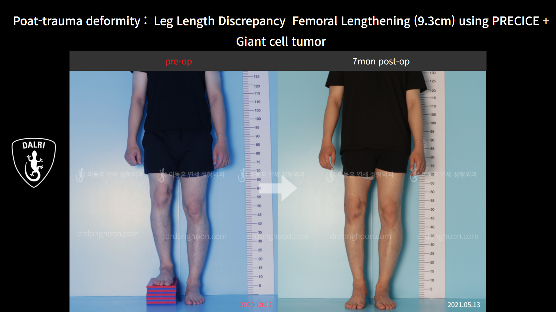 Before and after post-trauma deformity, case 8606746, image 1, Dr. Donghoon institute (DALRI)