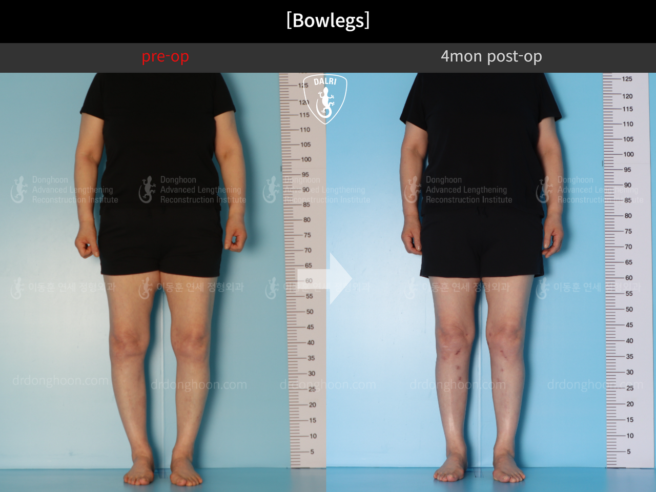 Before and after adult bowlegs, case 12586483, image 3, Dr. Donghoon institute (DALRI)