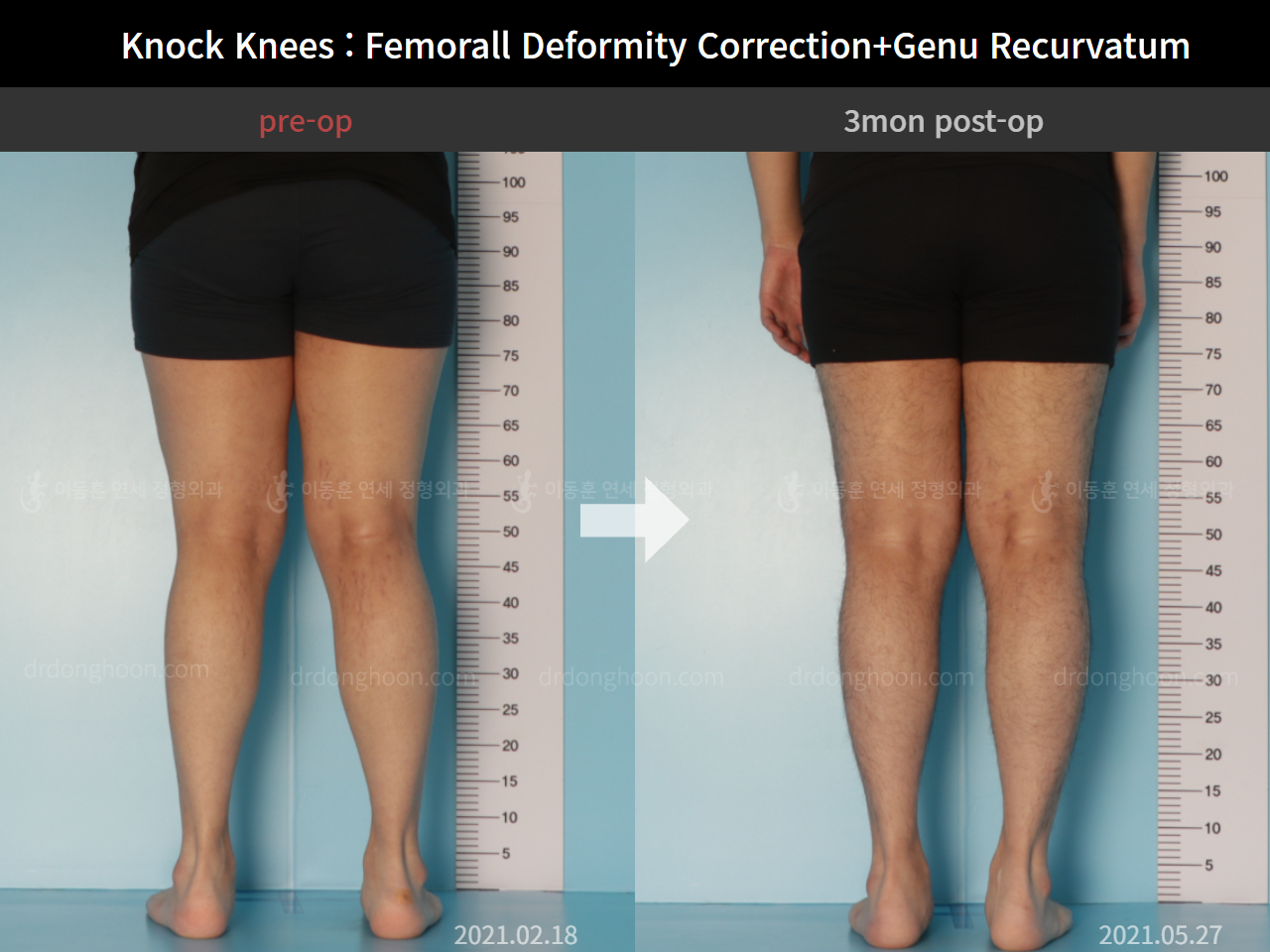 Before and after adult knock knees, case 7165631, image 4, Dr. Donghoon institute (DALRI)