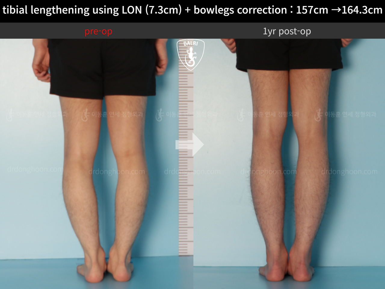 Before and after cll + deformity correction, case 13152543, image 6, Dr. Donghoon institute (DALRI)