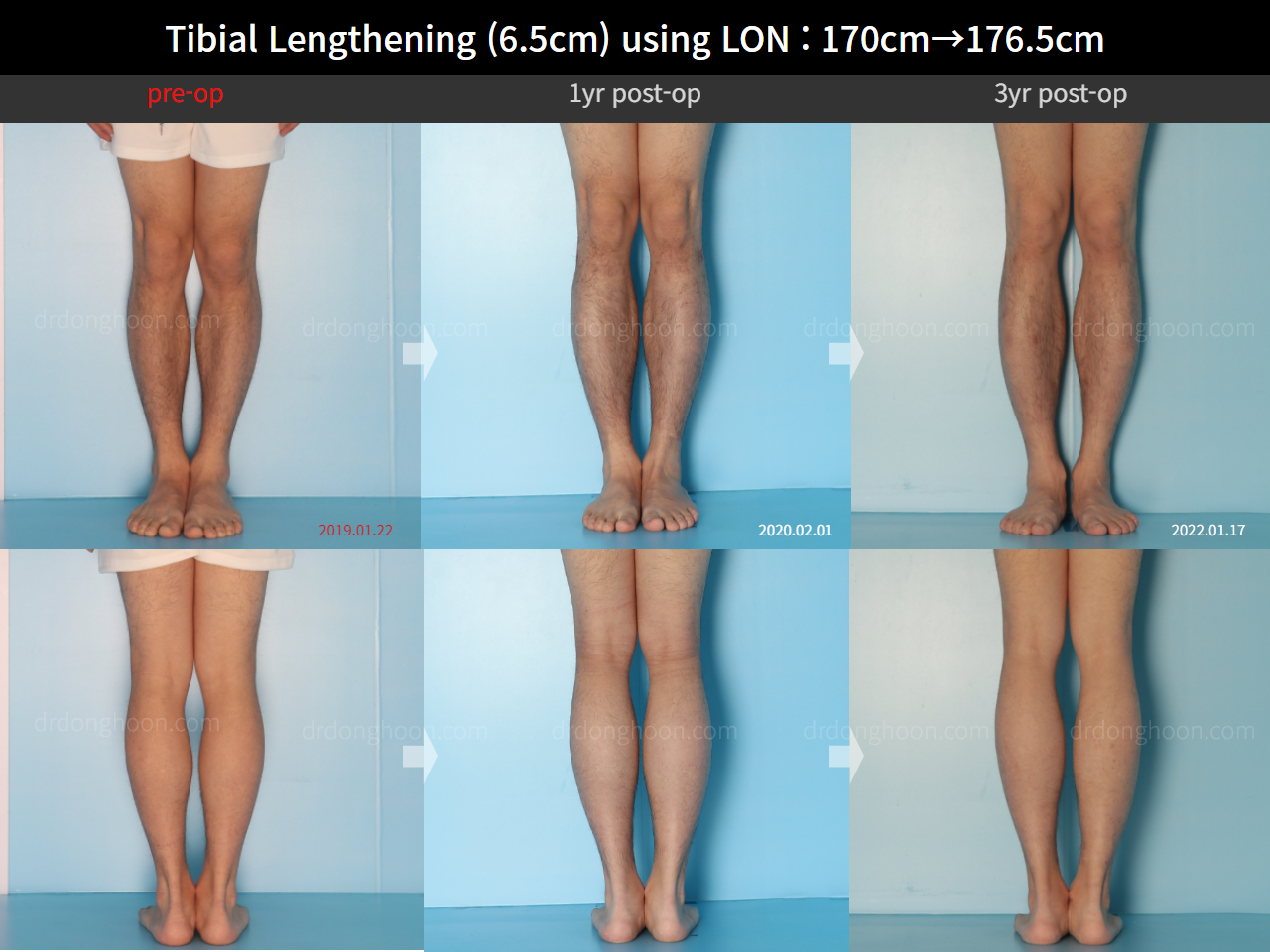 Before and after cll lon, case 16299082, image 9, Dr. Donghoon institute (DALRI)