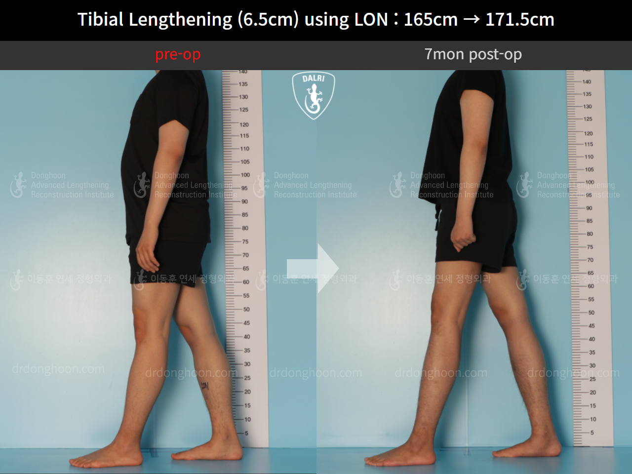 Tibial Lengthening 6.5cm using LON 165cm 171.5cm DALRI before after