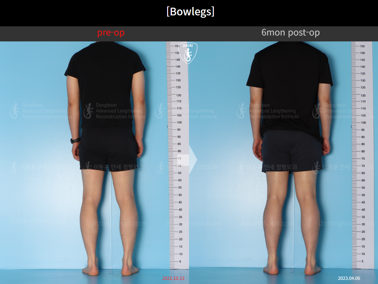 Before and after adult bowlegs, case 14742489, image 5, Dr. Donghoon institute (DALRI)