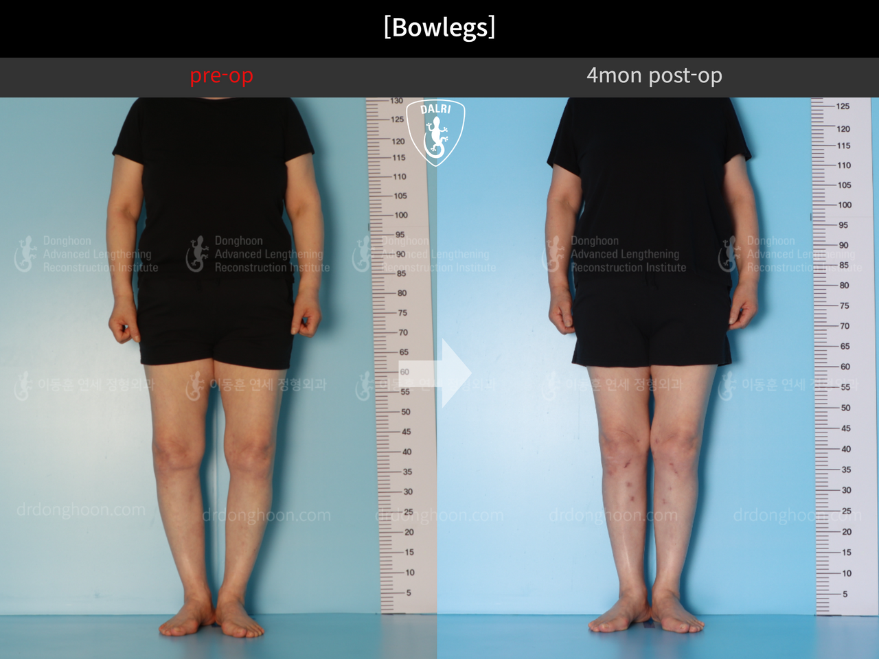 Before and after adult bowlegs, case 12586483, image 2, Dr. Donghoon institute (DALRI)