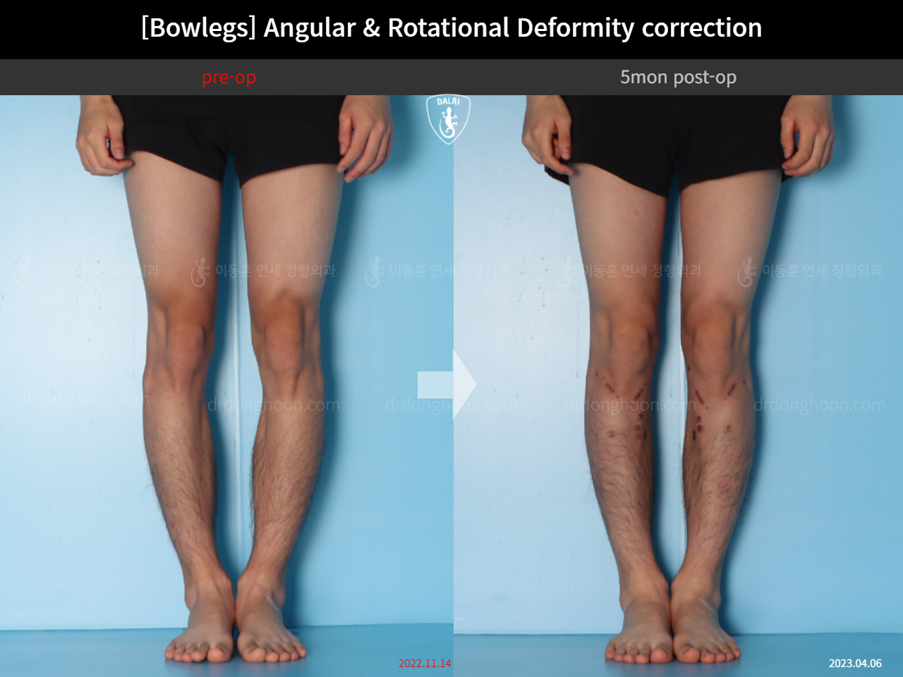 Before and after adult bowlegs, case 14707617, image 7, Dr. Donghoon institute (DALRI)
