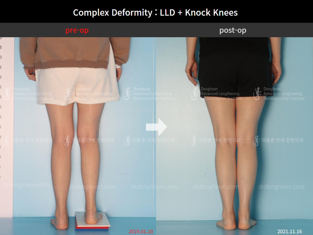 Before and after complex deformity, case 9041567, image 5, Dr. Donghoon institute (DALRI)