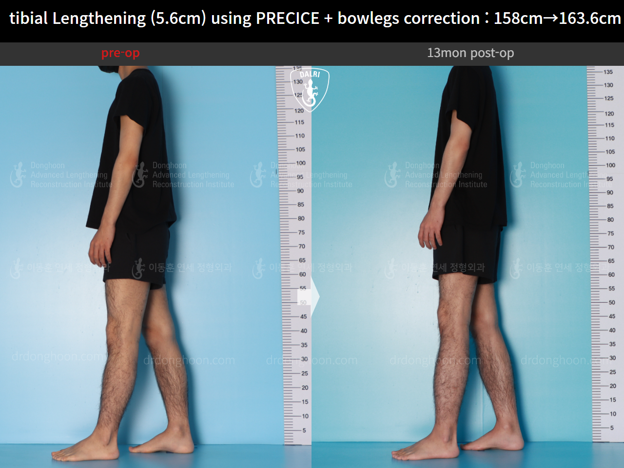 Before and after cll precice, case 16213622, image 5, Dr. Donghoon institute (DALRI)