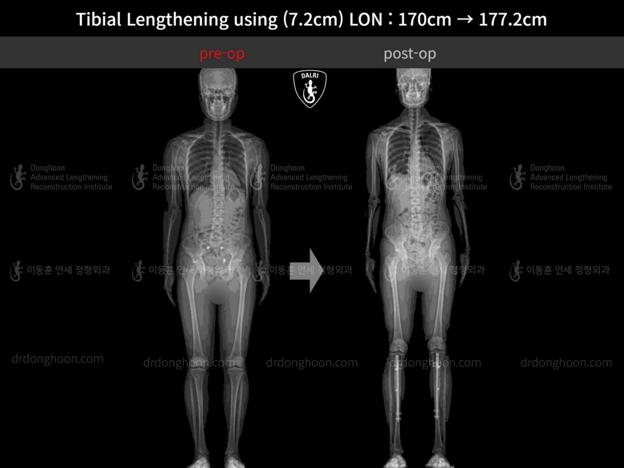 Before and after cll lon, case 13119626, image 1, Dr. Donghoon institute (DALRI)