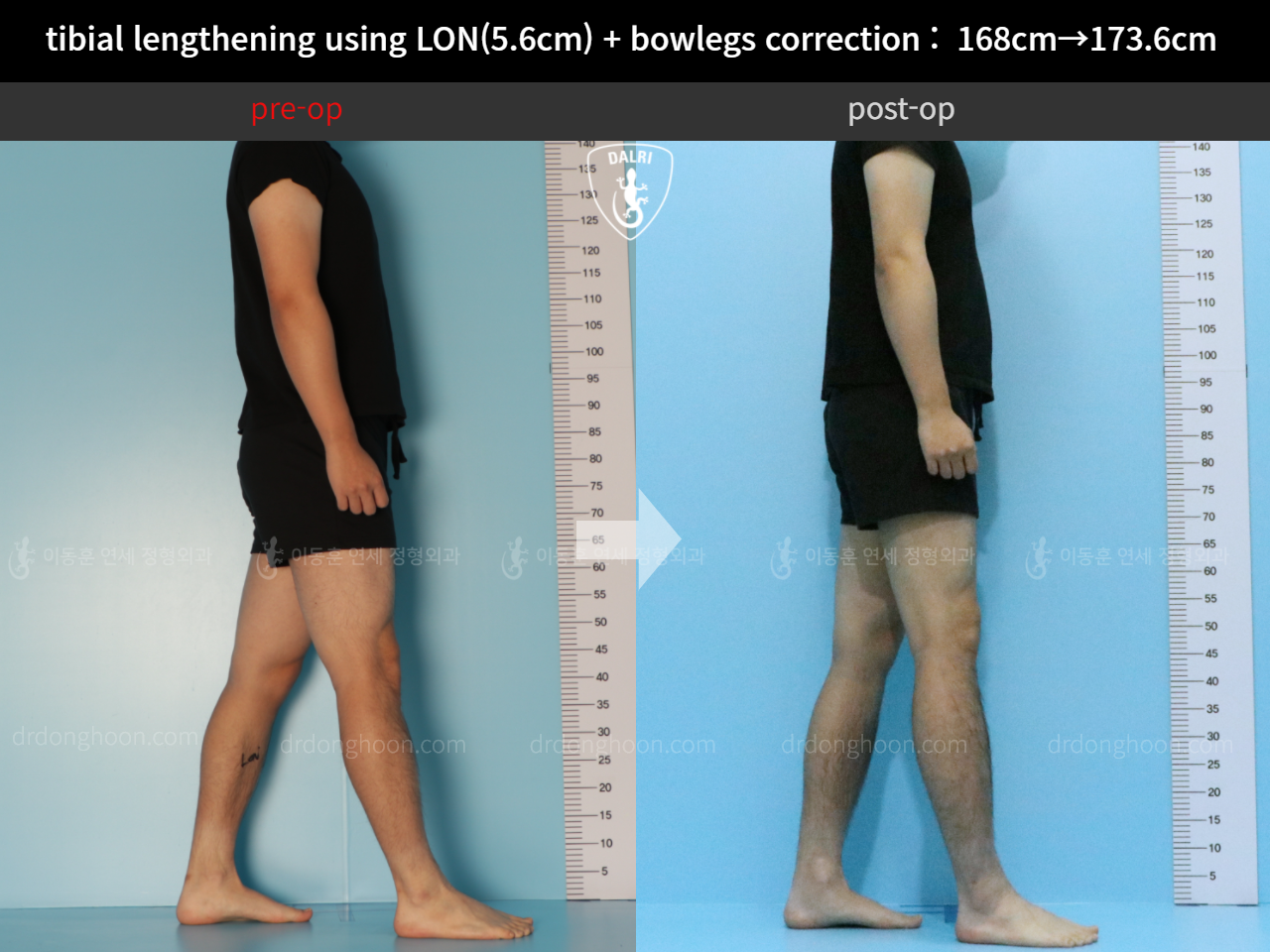 Before and after cll + deformity correction, case 11802994, image 3, Dr. Donghoon institute (DALRI)