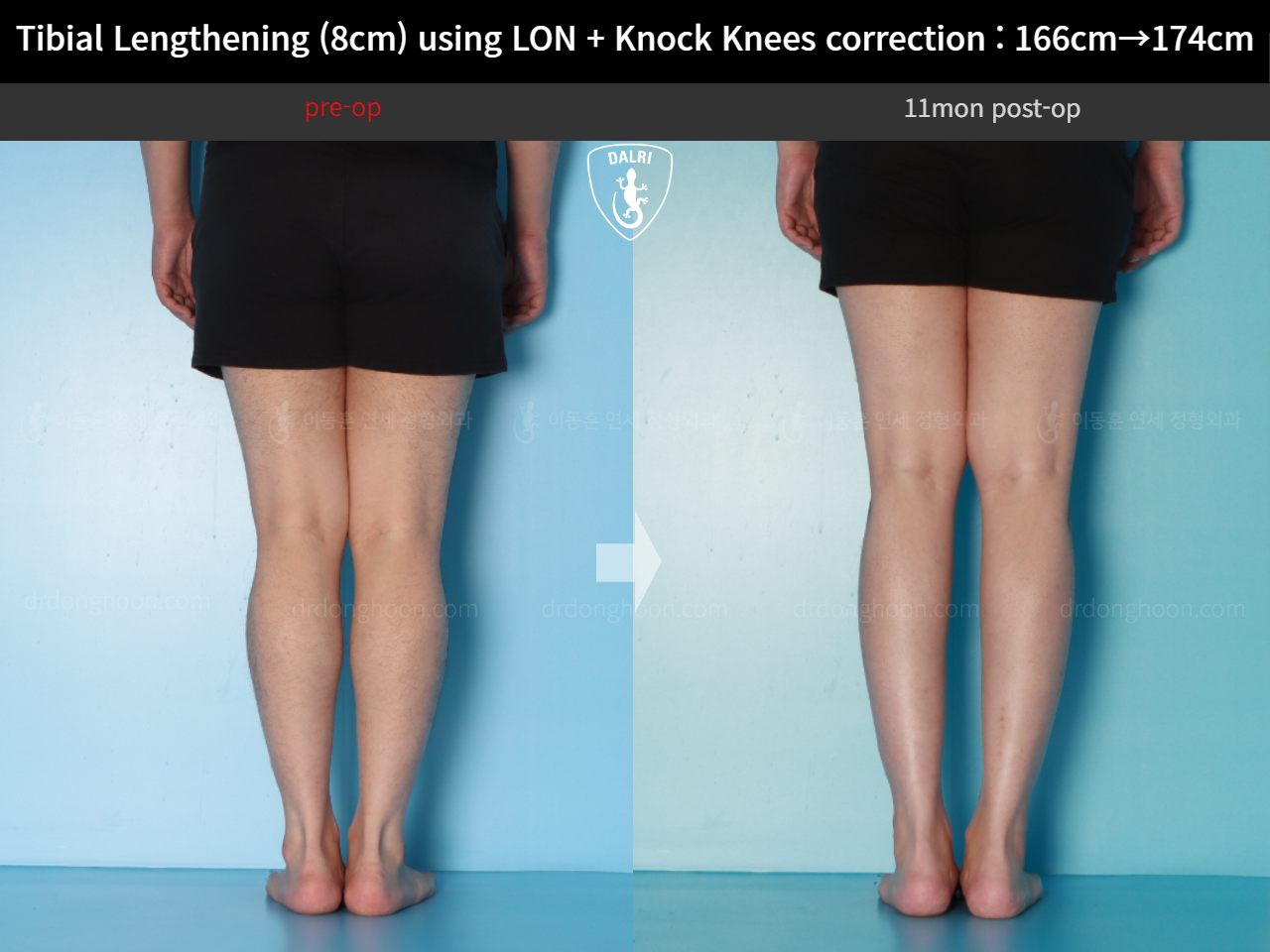Before and after cll + deformity correction, case 20789954, image 8, Dr. Donghoon institute (DALRI)