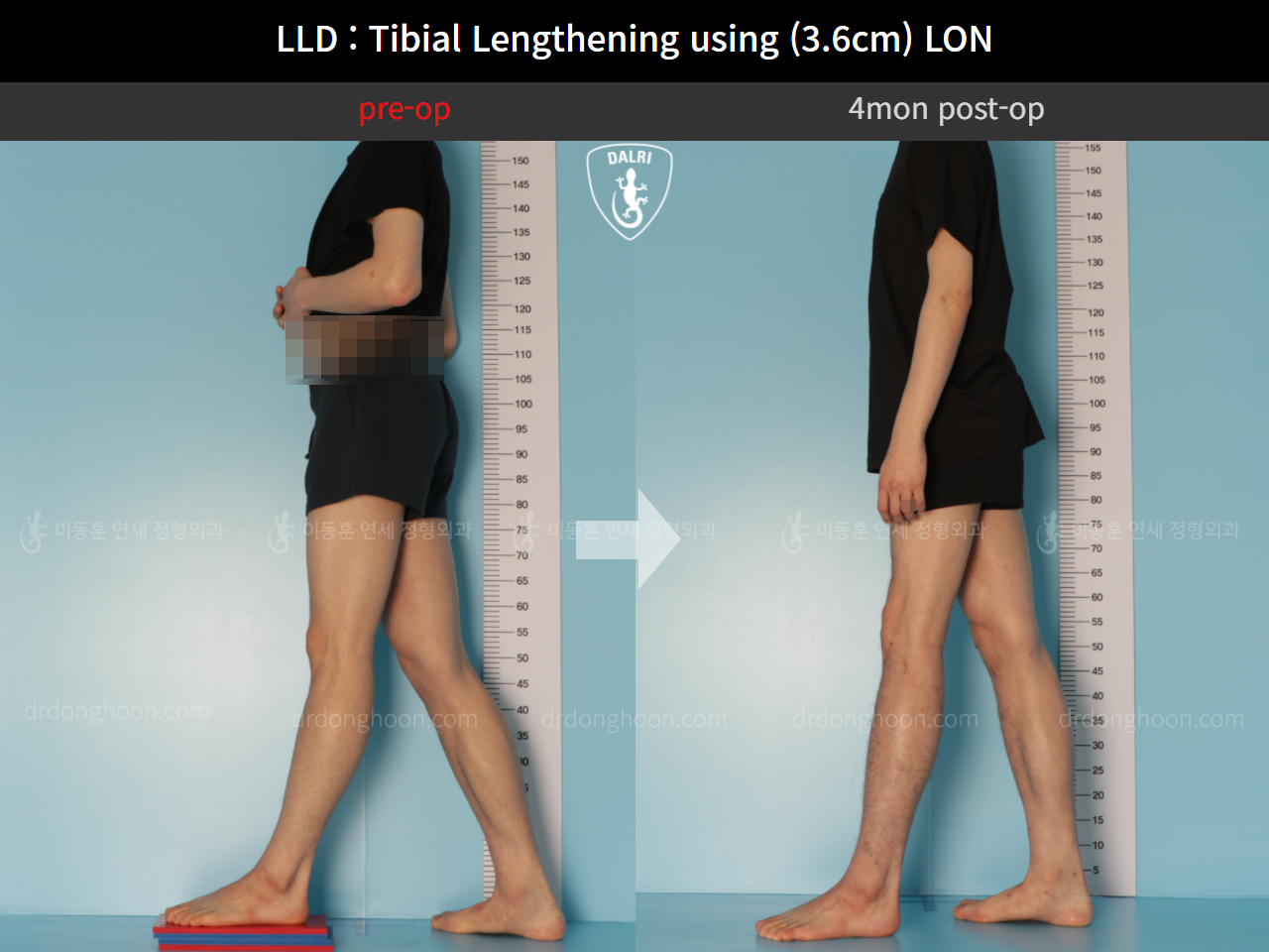 Before and after adult lld, case 11093753, image 3, Dr. Donghoon institute (DALRI)