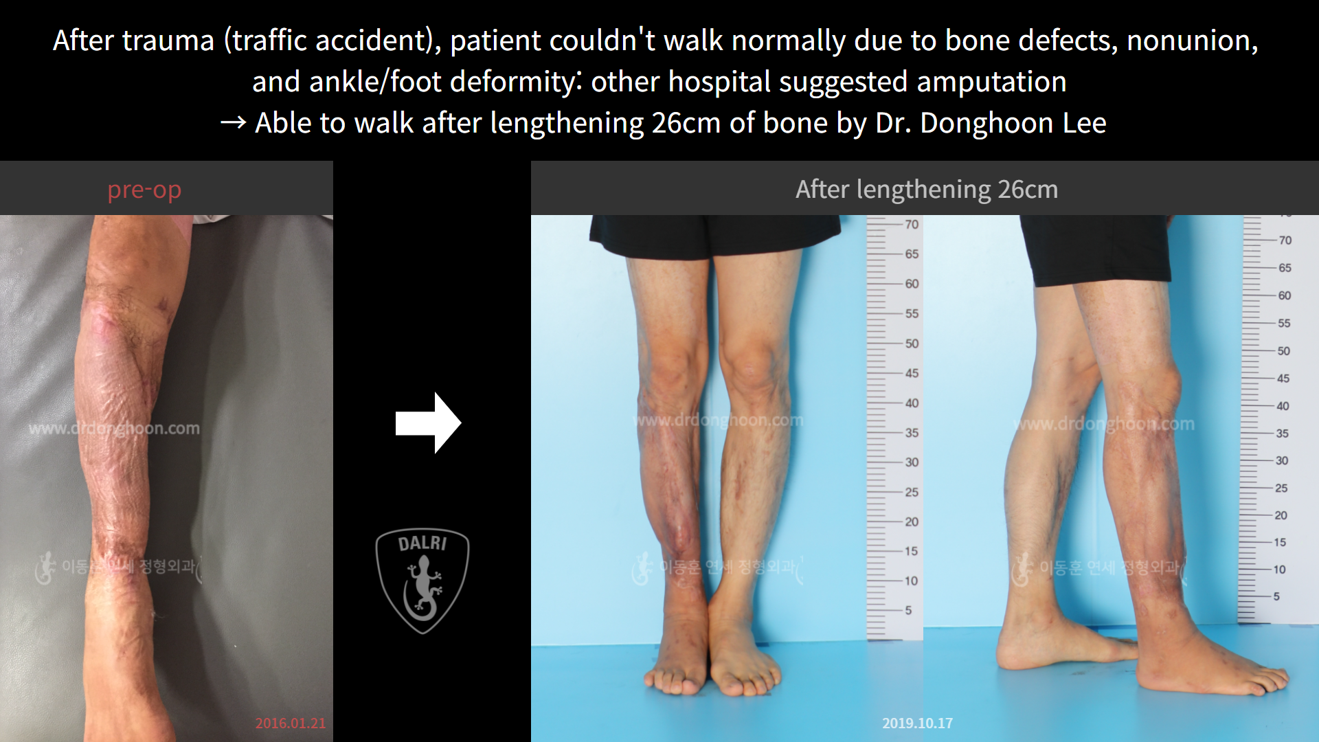 Before and after post-trauma deformity, case 7725984, image 4, Dr. Donghoon institute (DALRI)