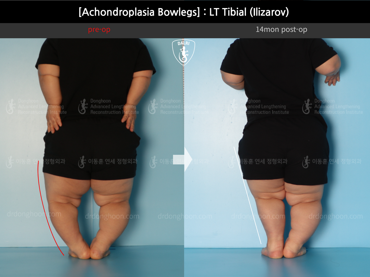 Before and after congenital condition, case 14296141, image 2, Dr. Donghoon institute (DALRI)