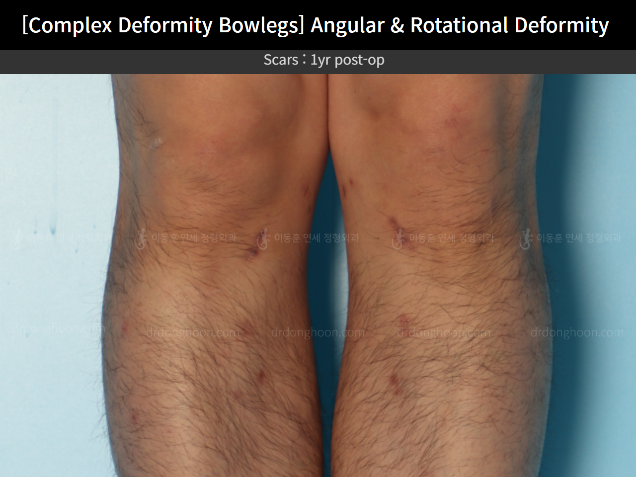 Before and after adult bowlegs, case 17229195, image 8, Dr. Donghoon institute (DALRI)