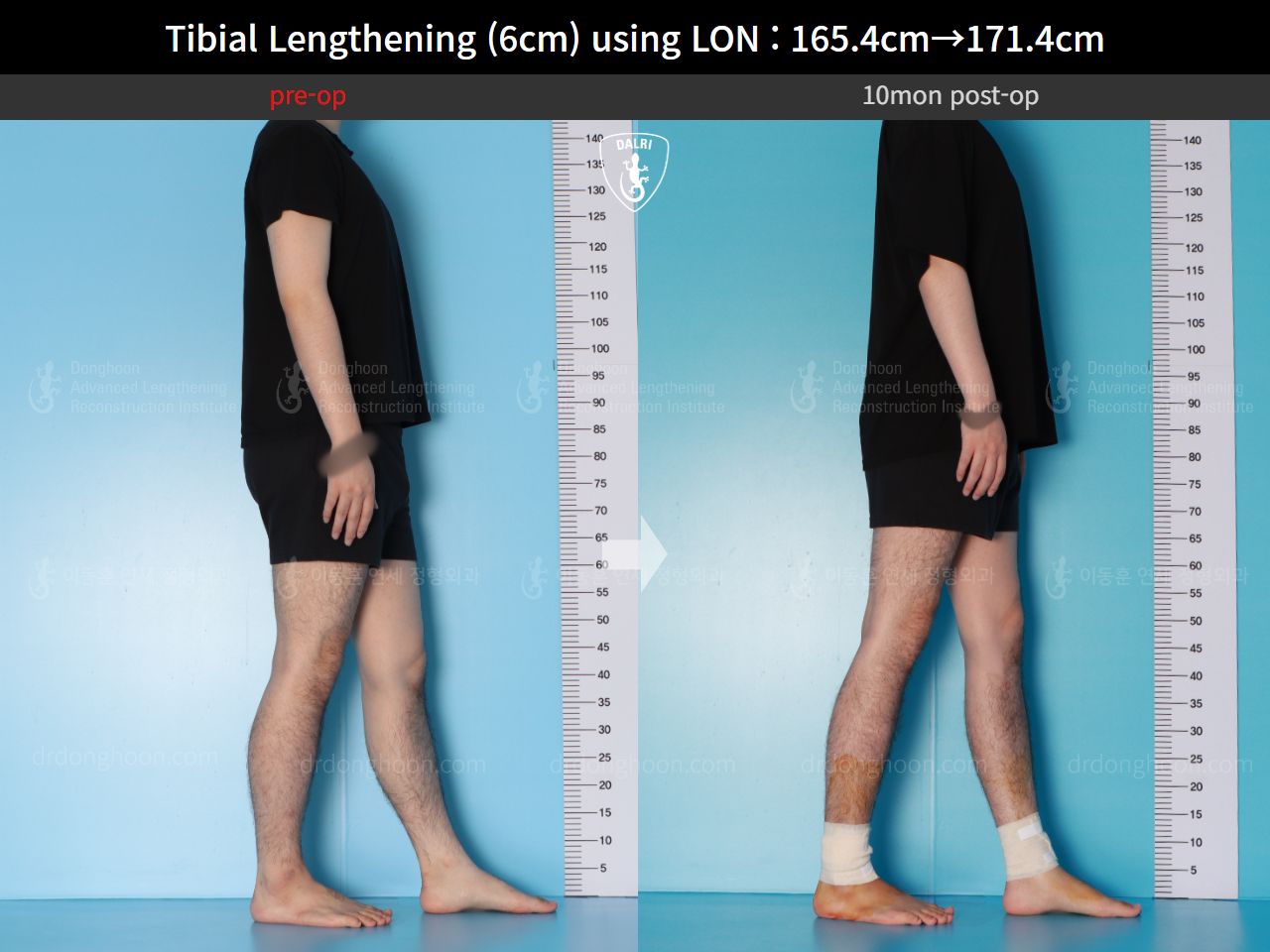 Before and after cll lon, case 15716525, image 8, Dr. Donghoon institute (DALRI)