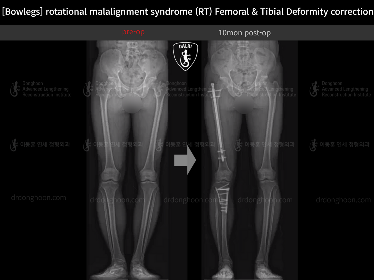Before and after adult bowlegs, case 14220550, image 10, Dr. Donghoon institute (DALRI)