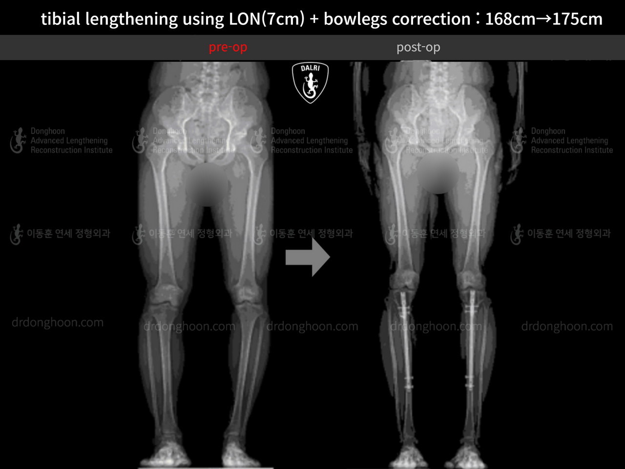 Before and after cll + deformity correction, case 13418393, image 2, Dr. Donghoon institute (DALRI)