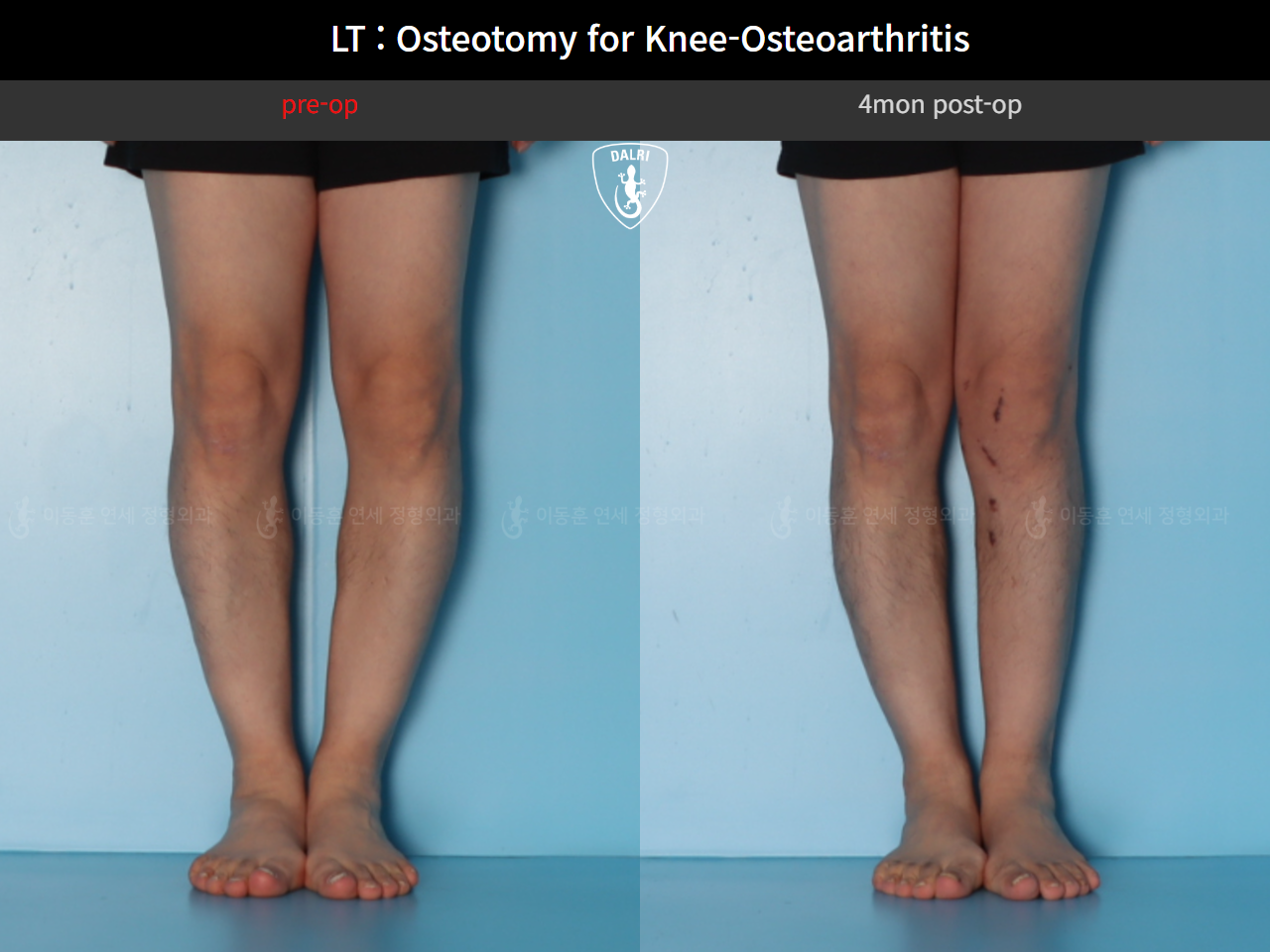 Before and after osteotomy for knee osteoarthritis, case 128374850, image 6, Dr. Donghoon institute (DALRI)